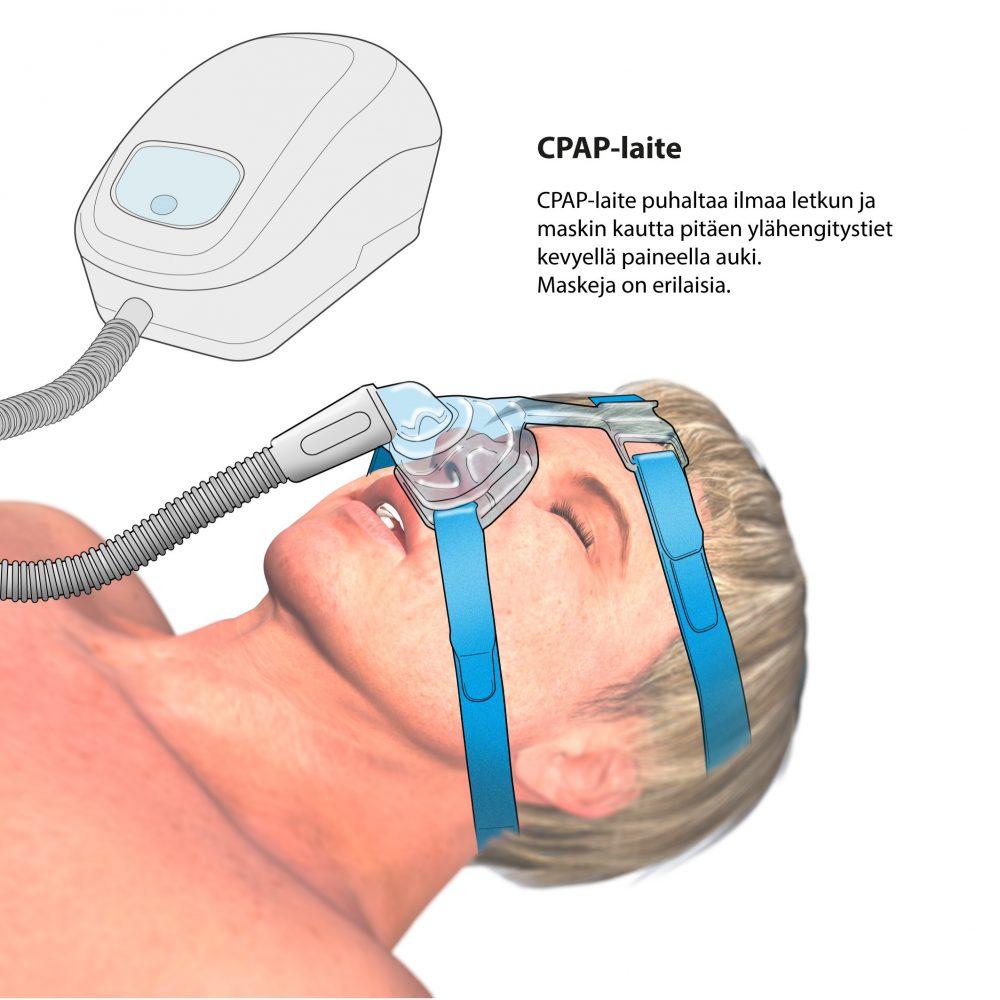 CPAP-laitteen käyttöä kuvastava piirroskuva. CPAP-laite puhaltaa ilmaa letkun ja maskin kautta pitäen ylähengitystiet kevyellä paineella auki. Kuvassa on nenämaski, mutta maskeja on erilaisia.